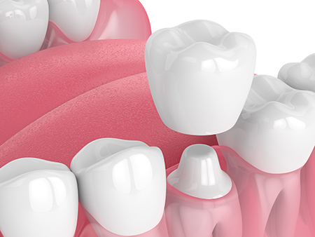 The image shows a collection of artificial teeth and gums set against a pink background, with a focus on the dental implants details and colors.