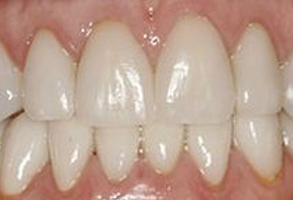 The image shows a close-up of a person s teeth with a focus on a dental implant, highlighting its integration into the natural teeth.