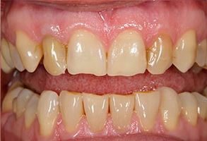 The image shows two close-up photographs of a person s teeth with severe dental decay and discoloration, emphasizing oral health issues.