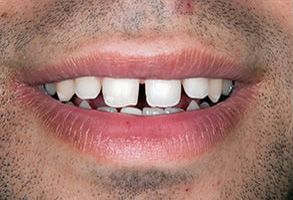 The image shows a close-up of a person s face with an exaggerated smile revealing multiple teeth and gums, which suggests that this could be an advertisement for dental care or a similar service.